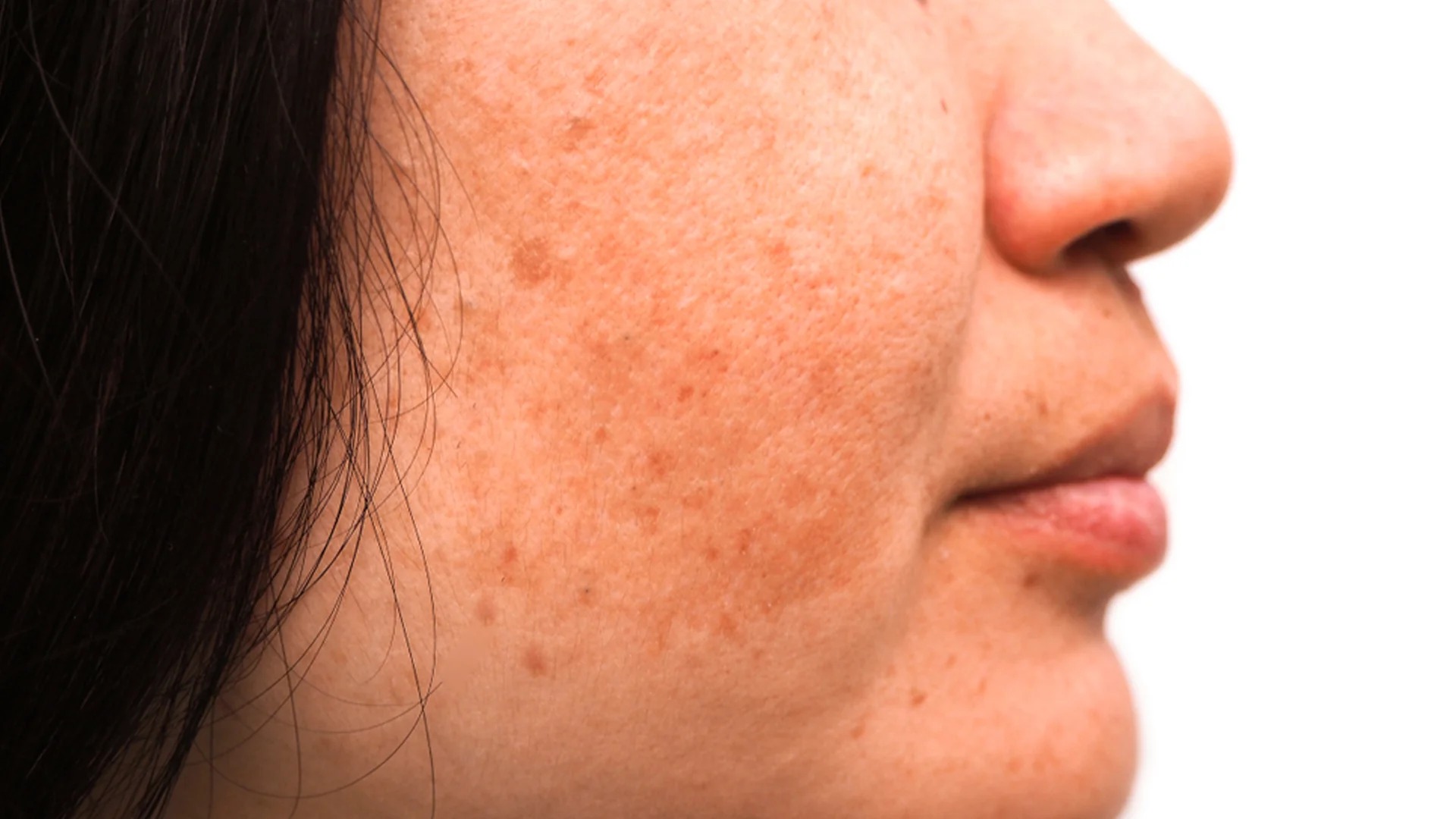 Nám da là hiện tượng tăng sắc tố trên bề mặt da, gây nên các vết đốm sạm trên da